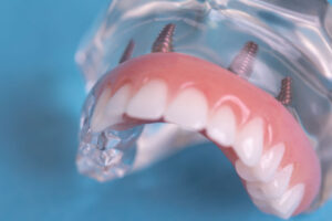 full arch dental implant model