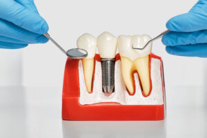 dental implant model