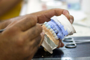 full mouth dental implant model
